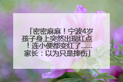 密密麻麻！宁波4岁孩子身上突然出现红点！连小便都变红了……家长：以为只是摔伤